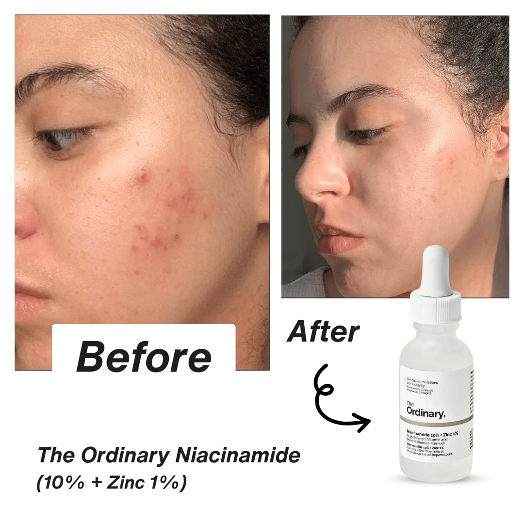 The Ordinary Niacinamide 10% + Zinc 1%