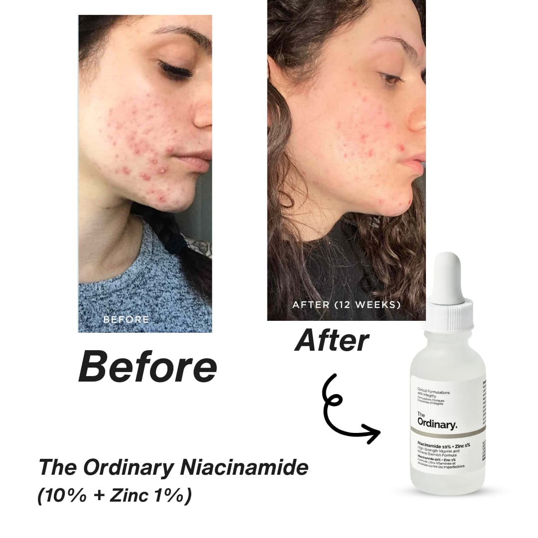 The Ordinary Niacinamide 10% + Zinc 1%